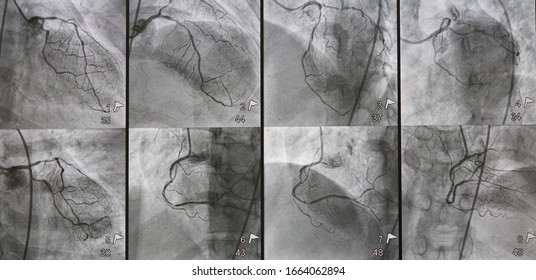 Coronary Angiogram (CAG) Was Performed Left And Right Coronary Artery Stenosis In Multiple Views.