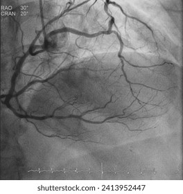 Coronary angiogram (CAG) was performed left and right coronary artery stenosis with left main (LM) anomalous origin from right coronary cusp (RCC).
