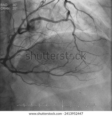 Coronary angiogram (CAG) was performed left and right coronary artery stenosis with left main (LM) anomalous origin from right coronary cusp (RCC).