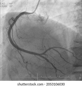 Coronary Angiogram (CAG) Was Performed Normal Right Coronary Artery (RCA).