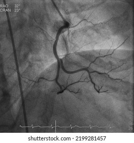 Coronary Angiogram (CAG) Was Performed Normal Right Coronary Artery (RCA).