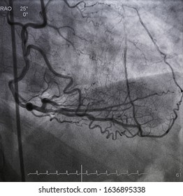 Coronary Angiogram (CAG) Was Performed Right Coronary Artery (RCA) Stenosis With Collateral To Left Anterior Descending Artery (LAD).