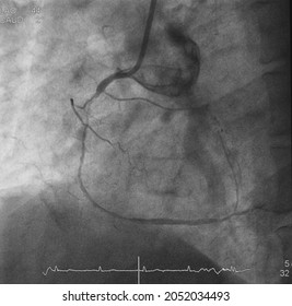 Coronary Angiogram (CAG) Was Performed Right Coronary Artery (RCA) Stenosis.