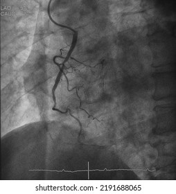 Coronary Angiogram (CAG) Was Performed Right Coronary Artery (RCA) Stenosis.