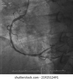 Coronary Angiogram (CAG) Was Performed Right Coronary Artery (RCA) Stenosis.