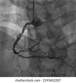 Coronary Angiogram (CAG) Was Performed Right Coronary Artery (RCA) Stenosis.