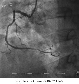 Coronary Angiogram (CAG) Was Performed Right Coronary Artery (RCA) Stenosis.