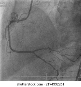 Coronary Angiogram (CAG) Was Performed Right Coronary Artery (RCA) Stenosis.