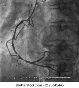 Coronary Angiogram (CAG) Was Performed Right Coronary Artery (RCA) Stenosis.