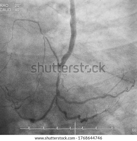 Coronary angiogram (CAG) was performed saphenous vein graft (SVG) to left circumflex artery (LCx) in patient post coronary artery bypass graft (CABG).