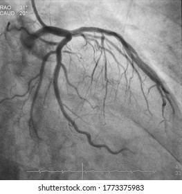 Coronary angiogram (CAG) was performed successful percutaneous coronary intervention (PCI) at proximal to mid left circumflex artery (LCx) with drug eluting stent (DES).
