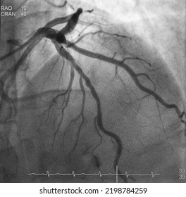 Coronary Angiogram (CAG) Was Performed Successful Percutaneous Coronary Intervention (PCI) At Diagonal Branch (DG) With Drug Eluting Stent (DES).