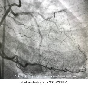 Coronary Angiogram In Dual Catheter Angiography Showed Chronic Total Occlusion (CTO) Of Left Anterior Descending Artery (LAD) With Collateral From Right Coronary Artery (RCA).