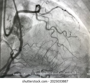 Coronary Angiogram In Dual Catheter Angiography Showed Chronic Total Occlusion (CTO) Of Left Anterior Descending Artery (LAD) With Collateral From Right Coronary Artery (RCA).