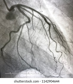 Coronary Angiogram Of Left Coronary Artery In Cardiac Catheterization Room