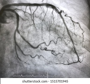 Coronary Angiogram Of Left Coronary Artery During Cardiac Catheterization.