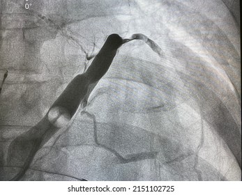 Coronary Angiogram Was Performed Coronary Sinus