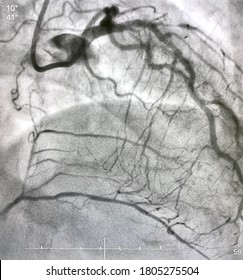 Coronary Angiogram Showed Chronic Total Occlusion (CTO) At Right Coronary Artery (RCA) With Collateral From Left Anterior Descending Artery (LAD).