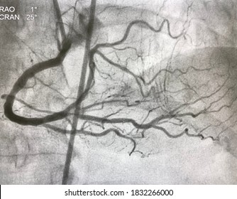 Coronary Angiogram Showed Right Coronary Artery (RCA) Given Collateral To Left Anterior Descending Artery (LAD) That Had Chronic Total Occlusion (CTO).