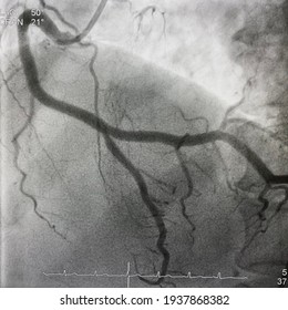 Coronary Angiogram Showed Right Coronary Artery (RCA) Given Collateral To Left Anterior Descending Artery (LAD) That Had Chronic Total Occlusion (CTO).