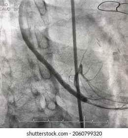 Coronary Angiogram Showed Saphenous Vein Graft (SVG) After Drug Eluting Stent (DES) Was Deployed During Percutaneous Coronary Intervention (PCI).