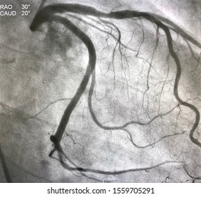 Coronary Angiogram Shown Left Coronary Artery Stenosis During Cardiac Catheterization.