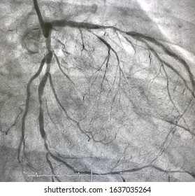 Coronary Angiogram Shown Left Coronary Artery Stenosis During Cardiac Catheterization.