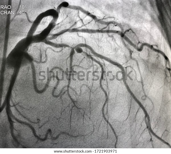 Coronary angiogram shown\
mid left anterior descending artery (LAD) stenosis during cardiac\
catheterization.