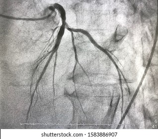 Coronary Angiogram Shown That Left Coronary Stenosis.