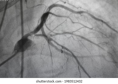 Coronary Angiography, Coronary Artery Disease. Medical X-ray Of Heart Disease. Healthcare And Medical Concept.