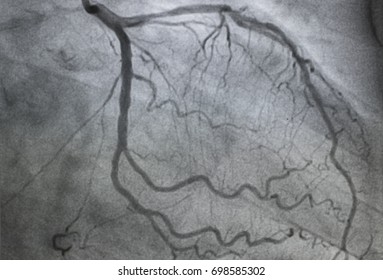 Coronary angiography , left coronary angiography , Left anterior coronary artery stenosis