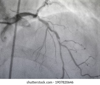 Coronary Angiography , Left Coronary Artery Disease.