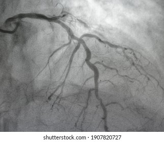 Coronary Angiography , Left Coronary Artery Disease.