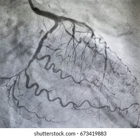 Coronary Angiography , Left Coronary Angiography , Left Circumflex Coronary Artery Stenosis