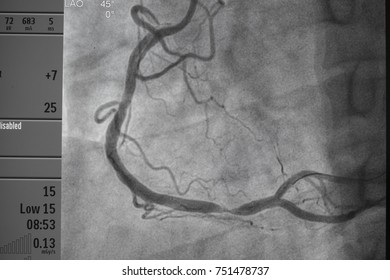 Coronary Artery Performed Very Tortuous Right Stock Photo (Edit Now