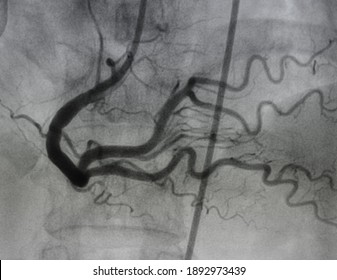 Coronary Angiography , Right Coronary Artery Disease.