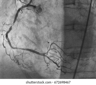 Coronary Angiography , Right Coronary Artery Stenosis