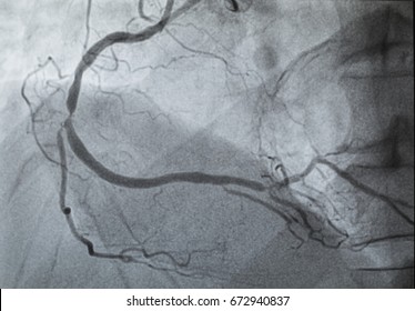 Coronary Angiography , Right Coronary Angiography , Right Coronary Artery Stenosis