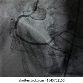 Coronary Artery Angiogram (CAG) Of Right Coronary Artery Stenosis Before Percutaneous Coronary Intervention (PCI) Procedures