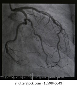 Coronary artery angiogram was performed left anterior descending artery (LAD), left circumflex artery (LCx) and obtuse marginal artery stenosis