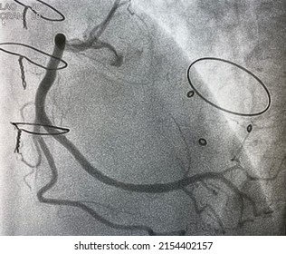 Coronary Artery Angiogram Was Performed Normal Right Coronary Artery (RCA)