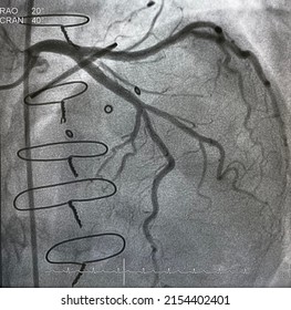 Coronary Artery Angiogram Was Performed Normal Left Coronary Artery