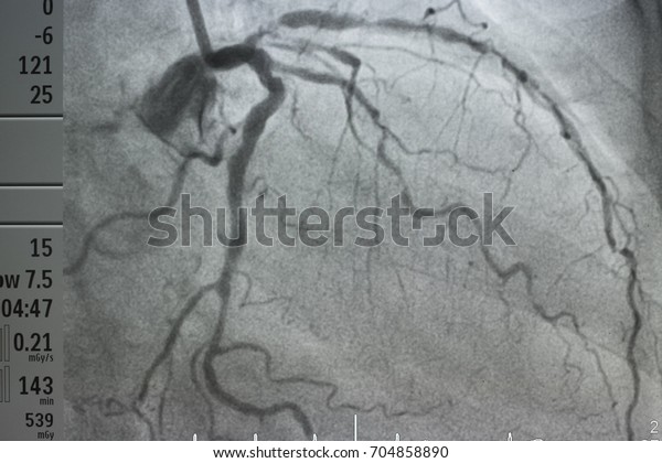 coronary artery angiography ,Coronary artery\
disease , left coronary\
angiography