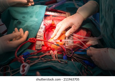 Coronary Artery Bypass Grafting