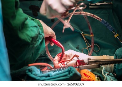 Coronary Artery Bypass Grafting