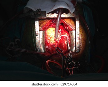 Coronary Artery Bypass Grafting