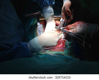 Coronary Artery Bypass Grafting