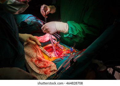 Coronary Artery Bypass Grafting