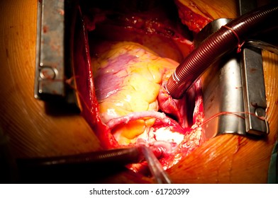 Coronary Artery Bypass Grafting On Open Heart