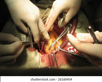 Coronary Artery Bypass Surgery